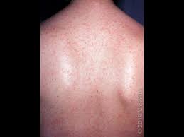 Image result for Rubella