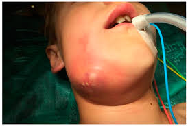 Image result for phlegmon on face)