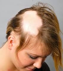 Alopesi Areata Nedir Sac Dokulme Tedavileri Dogal Sac Bakimi Saglikli Sac