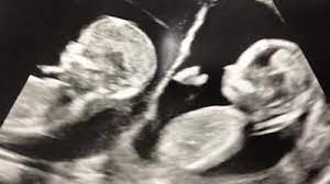 Zwillinge In Der 13 Woche Ssw12 Babywelten Ch