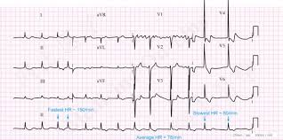 Ecg A Pictorial Primer