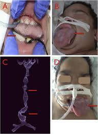 Severe enlargement of the tongue can cause cosmetic and functional difficulties in speaking, eating, swallowing and sleeping. Severe Macroglossia After Posterior Fossa And Craniofacial Surgery In Children International Journal Of Oral And Maxillofacial Surgery