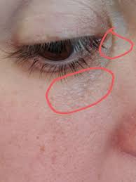 These white dots under eyes can affect anyone, from babies to a chalazion (chalazia for plural) is a clogged oil gland that often manifests itself as a white bump on eyelid. Under Eye Bumps Not Milia Beauty Insider Community