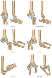 Image result for Elbow Dislocation