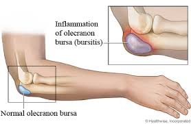 Strictly speaking, a hygroma is not a true bursitis, although it is occasionally characterized as such. Olecranon Bursitis Masnad Health Clinic