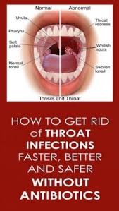 12 Effective Natural Home Remedies To Treat A Strep Throat Infection 12effectivenaturalhomeremediestotreatast Throat Infection Natural Home Remedies Remedies