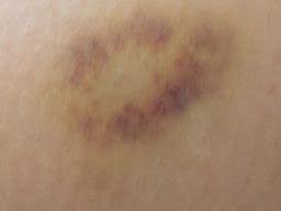 Bruise Colors Causes Timescale And When To See A Doctor