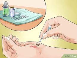 Beim duschen sollte man aber in der ersten zeit. Steri Strips Aufkleben 14 Schritte Mit Bildern Wikihow