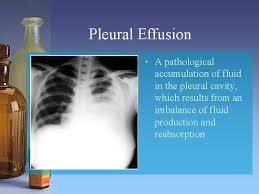 Benign pleural plaques of parietal pleura, usually bilateral, might be seen in addition to malignant pleural mesothelioma; Serous Effusions How The Clinical Biochemistry Lab Can