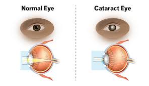 The star health insurance policies provide coverage for cataract surgery up to rs 30,000 per eye for each hospitalization or rs 40,000 in a policy tenure. What Are Cataracts Understanding Symptoms And Treatment