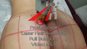 Affect but how about the hi, i underwent a laser hair removal on lower face 10th xxxxxxx , this was 6th. Professional Laser Hair Removal Full Buttocks Video 53 Youtube