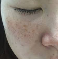 衝撃 シミに長年悩まされ続けた45歳女性 神アイテムを使ったら1ヶ月でシミが scarlet スカーレット シミ消し 美容 スキンケア