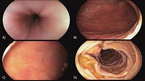 Image result for Colonoscopy in GI Bleeding