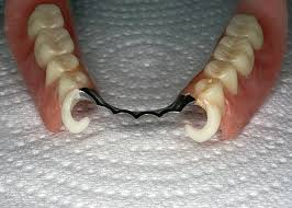 .gigi palsu lepasan, harga gigi palsu malaysia, harga gigi implant, harga gigi implan, harga gigi behel, harga gigi ratio satria 120, harga gigi sela beat pasang gigi palsu permanen oleh permata dental jember via permatadental.wordpress.com. Buang Gigi Palsu Dengan Ketiadaan Sebahagian Gigi Foto Yang Lebih Baik Untuk Rahang Atas Dan Bawah