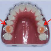 A wide variety of pillow brace options are available to you, such as function, is_customized, and material. Life With Braces Arizona Orthodontist Advanced Orthodontics