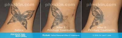 Tattoos continue fading for months after the treatments have been completed. Picosure Laser Tattoo Removal Laser Tattoo Removal At Home