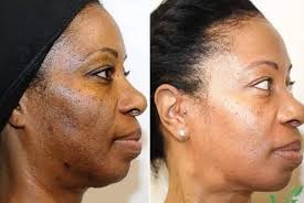 Kojic Acid Turmeric Soap: Lemon & Honey, Handcrafted