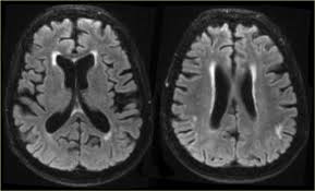 Lewy body dementia is the second most common cause of dementia after alzheimer's disease. The Radiology Assistant Dementia Role Of Mri