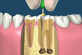 Curs Intensiv De Endodontie La Microscop In Bucuresti Kerr Endodontics Si Leica Organizeaza In Data De 11 13 Mai Root Canal Happy Dental Root Canal Treatment