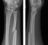 Isolated Ulnar Shaft Fracture - Trauma - Orthobullets