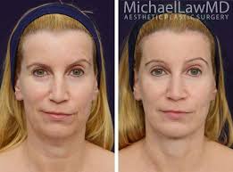 Facial Implants Photo Gallery Undereyesmask Facial Implant Facial Rejuvenation Facial Plastic