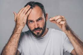 Evitar La Caida Del Cabello En Hombres Que Funciona