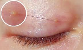 Zápaly kĺbov ruky a zápästia môžu byť infekčné a neinfekčné. Lipom Na Osetrenie Ocnych Viecok Tvorba Wen Na Ocne Viecko A Dalsie Akcie