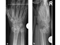2.4 mm VA-LCP Volar Rim Distal Radius Plate