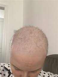 This part of the cancer journey is one of the hardest to go through. Hair Growth After Chemo Macmillan Online Community