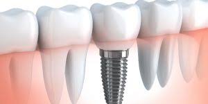 Vitaleurope is a leading dental clinic based in central london and budapest. Dental Implants Cost 480 Cosmetic Dentistry In London Uk