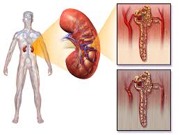We did not find results for: Diabetic Nephropathy Ireland Pdf Ppt Case Reports Symptoms Treatment