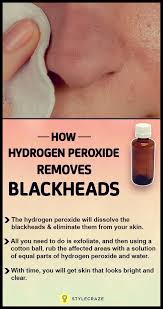How To Use Hydrogen Peroxide To Remove Blackheads Cystic Acne Treatment Beauty Care Acne Treatment