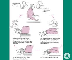 Image result for Canalith Repositioning Procedure