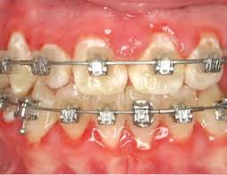At marana sky dental, we believe in a strong preventive program. Types Of Appliances Orthodontist Cedarburg Wi Mantel Orthodontics