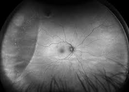 Some times the retinal vessels on the detachment will be dark in appearance, as seen in a retinoschisis. Retinal Holes And Tears Recognizing Pathology Optos