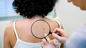 If skin cancer doesn't scare you, how about premature aging of your skin due to sun damage? Skin Cancer Signs Symptoms Treatment And More Everyday Health