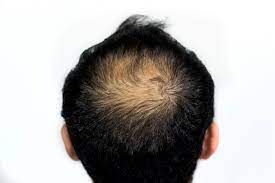 A bald spot in the crown may be a good indication that you are losing hair for genetic reasons but isn't necessarily the case. Hair Loss In Men Boss Clinic