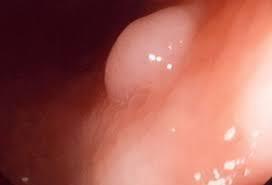 The american cancer society estimates there will be more than 140,000 new cases of colorectal cancer diagnosed in the united states in 2018. Colon Cancer Symptoms Signs Screening Stages