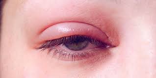 Apakah anda sedang mengalami mata merah? Kelopak Mata Bengkak Ini Penyebab Dan Cara Mengobatinya