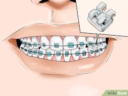 Check spelling or type a new query. How To Connect A Rubber Band To Your Braces 12 Steps