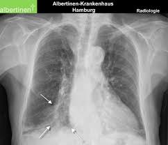 Tissue biopsies and advanced imaging scans are required to make an official pleural mesothelioma diagnosis. X Ray Of The Thorax P A Atelectasis Of The Middle Lobe Doccheck