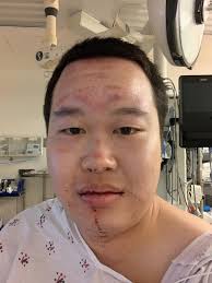 Electric Scooter Accident and Safety Discussion