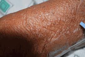 Hiv kills or damages the body's immune system cells. Disseminated Rash Accompanied By Abdominal Symptoms
