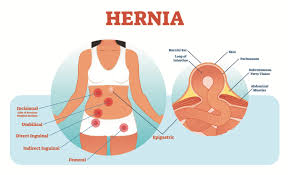 The standard female grab area trope as used in popular culture. Hernias Types Symptoms And When To Seek Urgent Care Md Express Urgent Care