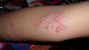 Image result for chicken pox