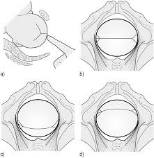 Image result for Manual Rotation in Occipitoposterior Presentation