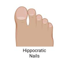 Image result for Clubbing nails feet