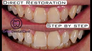 Penambalan Gigi Depan Dengan Resin Komposit Kelas Iv Direct Restoration Composite Class Iv Youtube