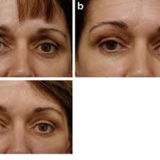 PDF) Nonsurgical Volumetric Upper Periorbital Rejuvenation: A Plastic  Surgeon's Perspective