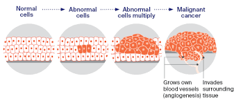 Cancer that starts in the lymph nodes is called lymphoma. What Is Cancer Cancer Council Nsw